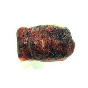 Simulaids Face Burn 3Rd Degree