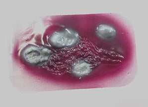 Simulaids 2nd Degree Burn Stickon