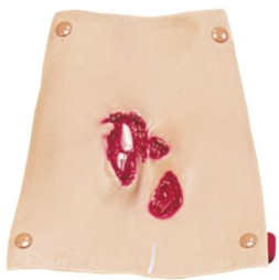 Simulaids Compound Femur Fracture Simulation