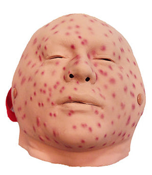 Nasco Smallpox Moulage, 2nd–3rd Day