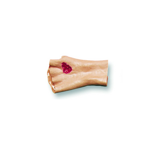 Simulaids Phosphorus Burn Hand Model
