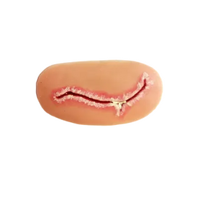 Nasco Level 3 Surgical Site Infection